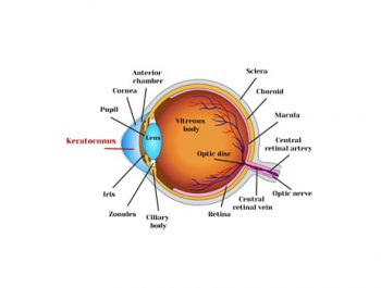 علاج انفصال شبکية العين
