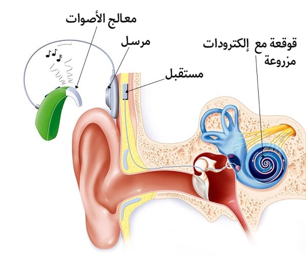 زراعة قوقعة الأذن