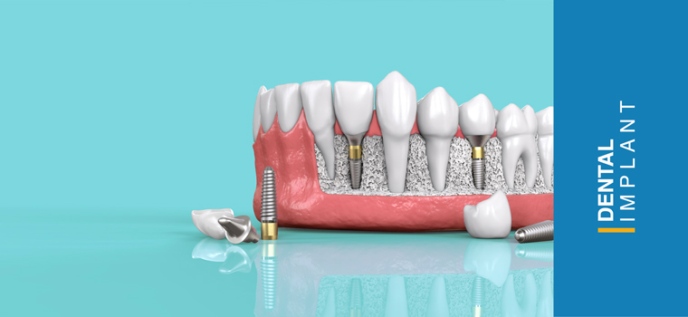 tooth implant
