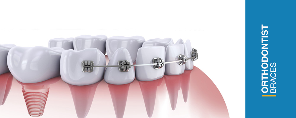 orthodontist braces