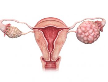 All you should know about ovarian cancer