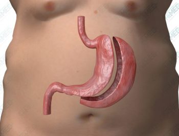 Gastrectomy (Stomach-Removal)