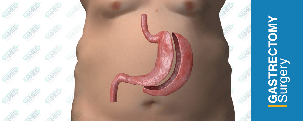 Gastrectomy (Stomach-Removal)