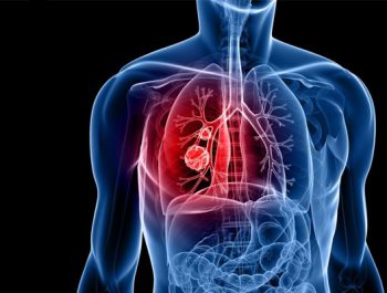 Lung cancer ;All you should know
