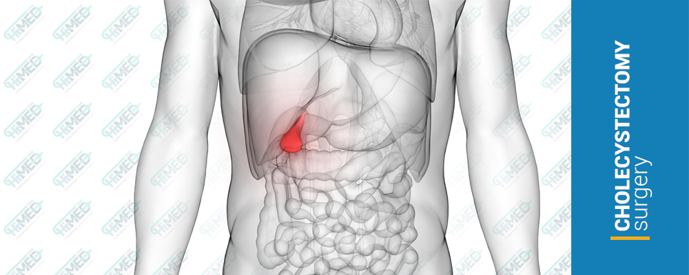 Cholecystectomy (Gallbladder-Removal Surgery)