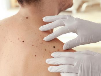روش‌های مختلف درمان سرطان پوست چه هستند؟