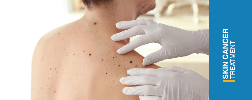 روش‌های مختلف درمان سرطان پوست چه هستند؟