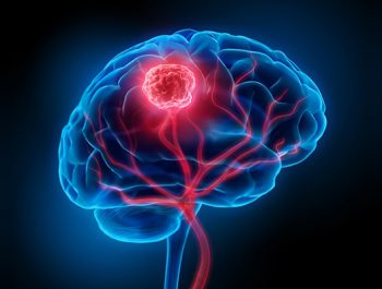 تومور مغزی ؛ علائم و روش‌های درمان آن