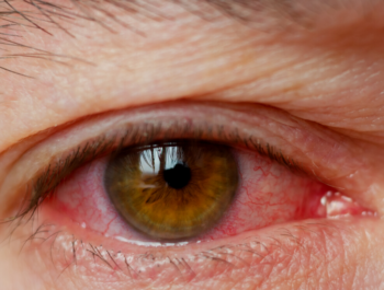 برای پیشگیری از گلوکوم و جلوگیری از نابینایی باید هر شش ماه معاینه چشم شوید